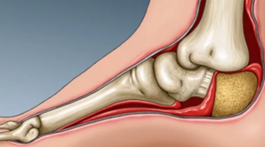 calcaneal-osteotomy-a-recovery-story