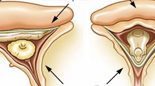 what-effacement-of-the-thecal-sac-means